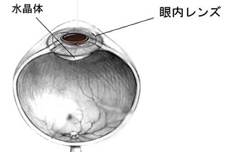 手術手順